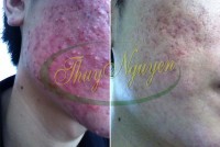 Điều Trị Mụn Bọc - Mụn Trứng Ca - Mụn Mũ - Thâm Rỗ Cho Khách Hàng Nam TN281116